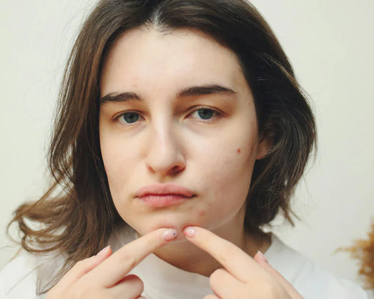 Best Natural Bar Soaps for Acne: Top Picks!